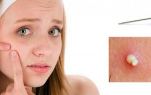 Ciltlerin Sivilceler ile İmtihanı