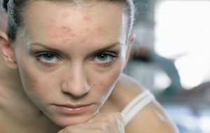 Sivilce İzlerine Karşı Güçlenmenin Zamanı!