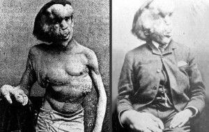 Fil Adam: Joseph Merrick