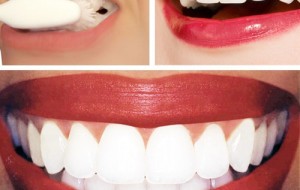 Diş Beyazlatıcı Ürünler nelerdir?