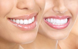 Diş Beyazlatma ücretleri ne kadardır?