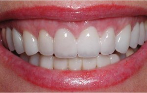 En Uygun İmplant Fiyatları