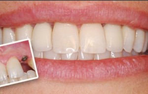 Implant nedir? Ne işe yarar? 