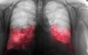 Lejyoner Hastalığı Nedir? Klima Hastalıkları Nelerdir?