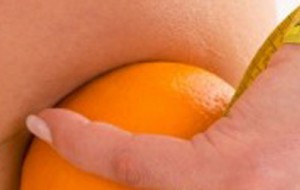 Selülit Tedavisi Yöntemleri