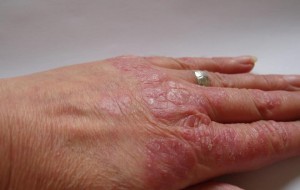 Sedef Hastalığı Ruh Sağlığı İçinde Çok Zararlı