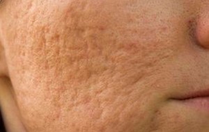 Ciltte Oluşan Gözenekler Nasıl Geçer?