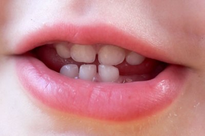 Süt Dişlerinin Önemi