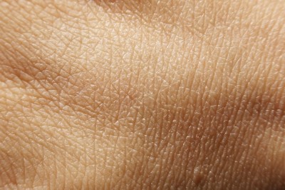 Cilt Kanseri Belirtileri Nelerdir ?